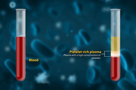 ACP Max Platelet-Rich Plasma (PRP) Injections