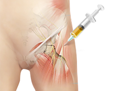 Platelet-Rich Plasma (PRP) Hip Injections