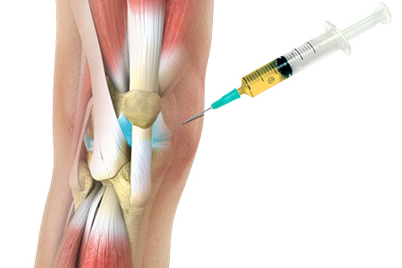 Platelet-Rich Plasma (PRP) Knee Injections